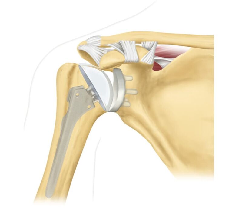 Replace the damaged shoulder joint with an endoprosthesis
