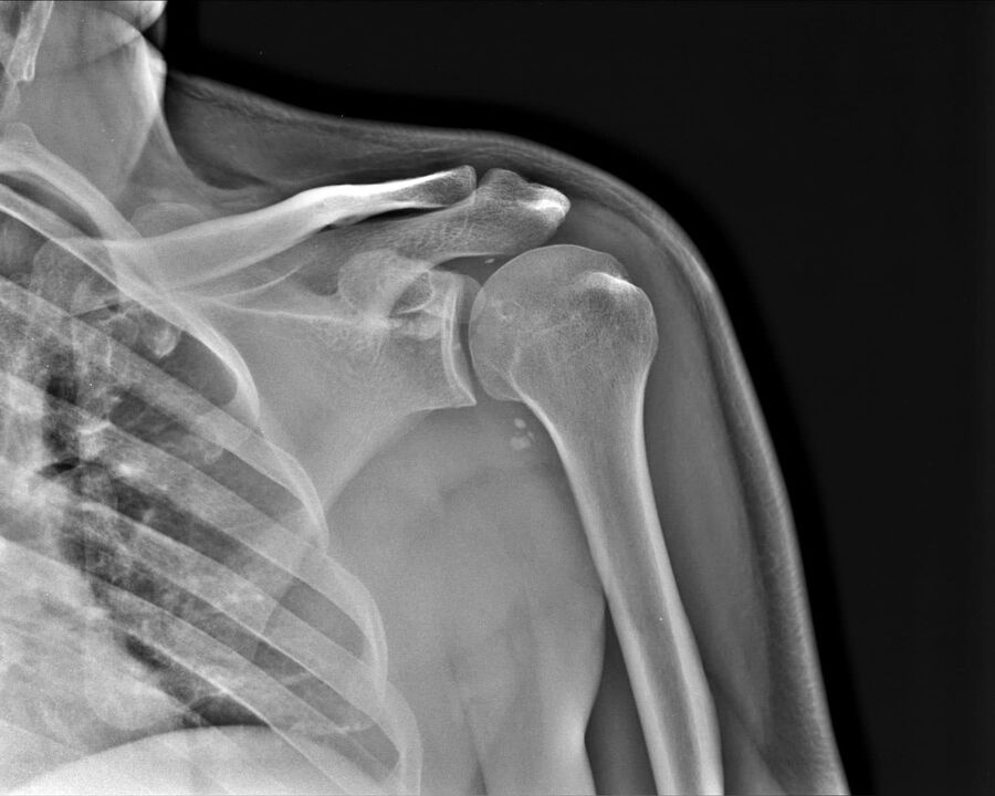 X-rays of Grade 2 Shoulder Joint Arthropathy