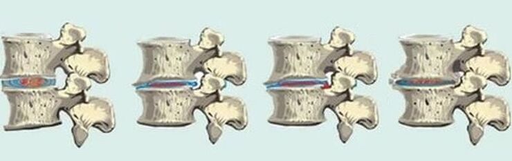 Spinal injury of thoracic osteochondrosis
