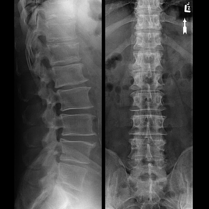 X-rays of the thoracic spine showing a reduction in the gap between the vertebrae along the spine from bottom to top