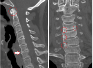 CT scan showing damaged vertebrae and discs with uneven height due to thoracic osteochondrosis