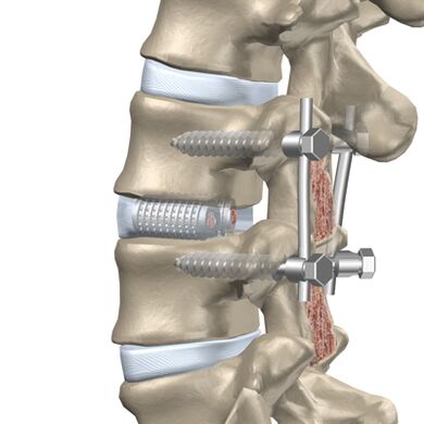 Replace damaged thoracic intervertebral discs with artificial implants
