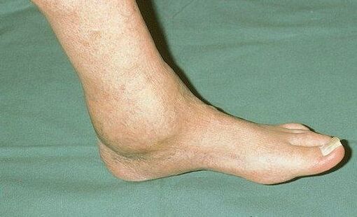 Swollen ankles with arthropathy