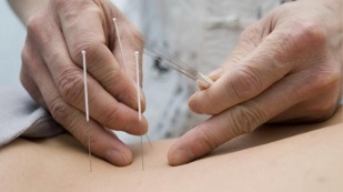 Acupuncture treatment of lumbar osteochondrosis