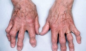 How to distinguish finger arthritis from arthritis