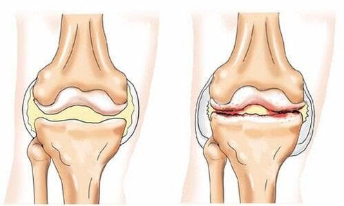 Healthy and Arthropathically Affected Knee Joints
