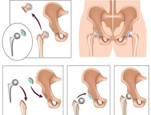 Endoprosthesis for hip arthroplasty