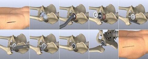 How to treat hip joints