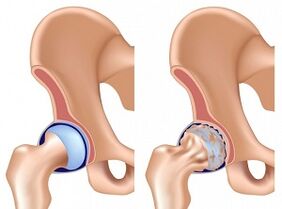 hip symptoms
