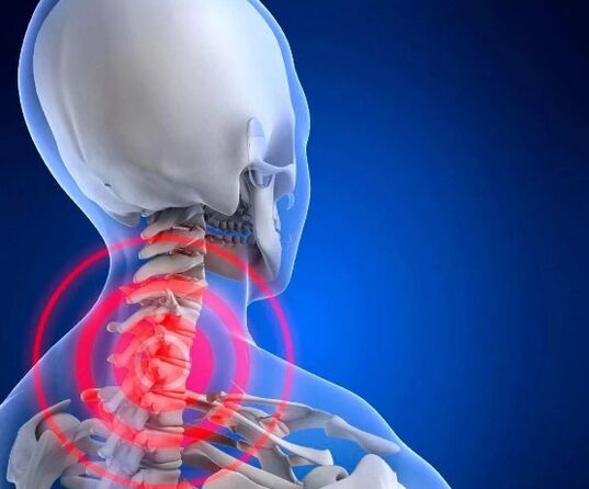cervical osteochondrosis