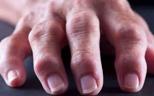Rheumatoid arthritis is the cause of joint pain